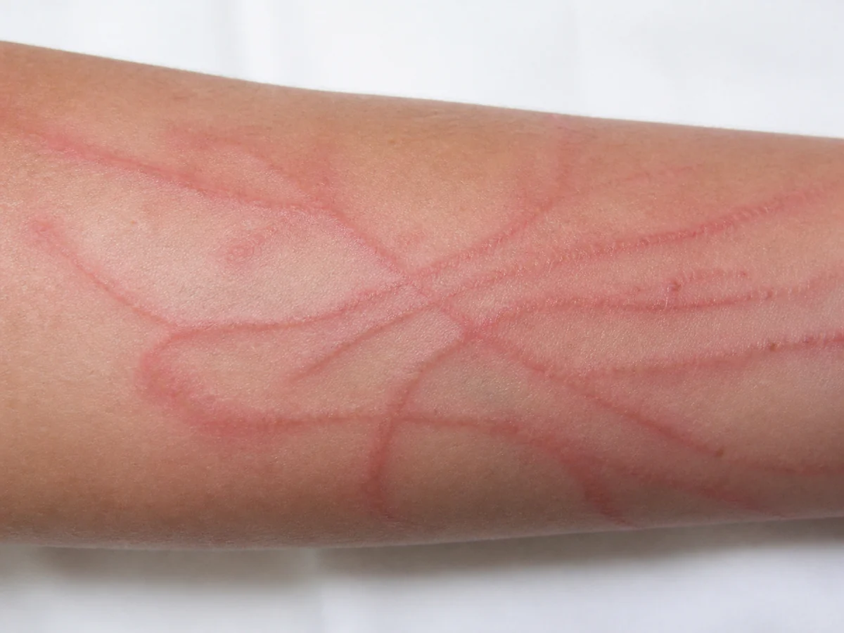Close view of a forearm with raised red linear streaks in an overlapping whip-like pattern